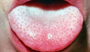 Hur man ska vara om en pimple poppade upp på tungan
