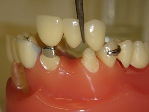 Karakteristisk beskrivning av dental broar